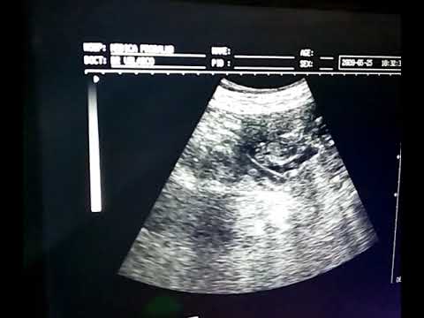 13 semanas de embarazo ecografia